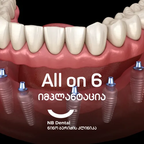 All on 6 იმპლანტაცია NB Dental-ში