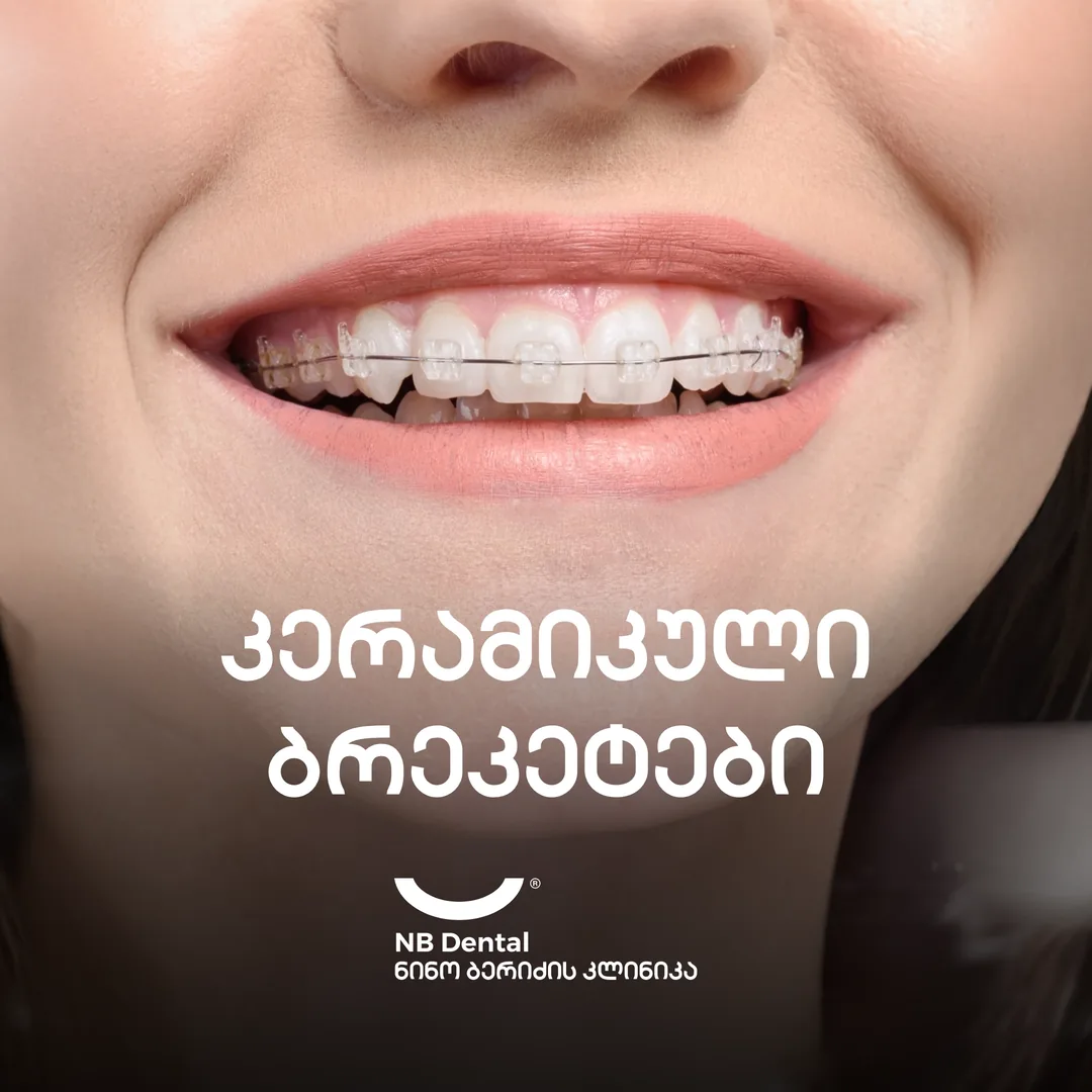 Керамические брекеты - ортодонтическое лечение в NB Dental