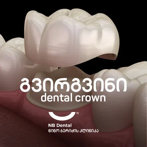 გვირგვინი - კბილის კერამიკული გვირგვინი NB Dental-ში