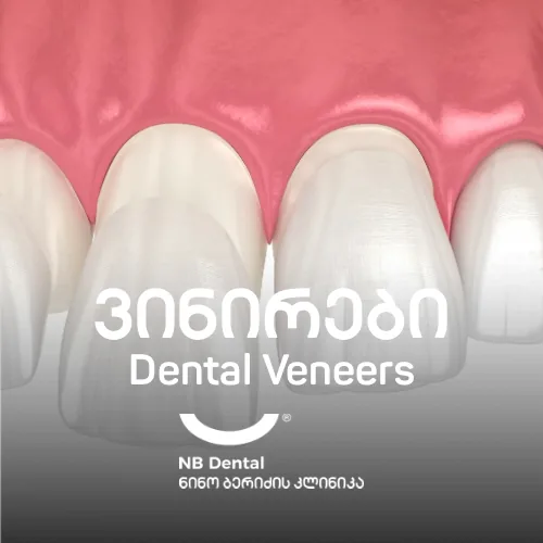 ვინირები - კერამიკული ვინირები NB Dental-ში