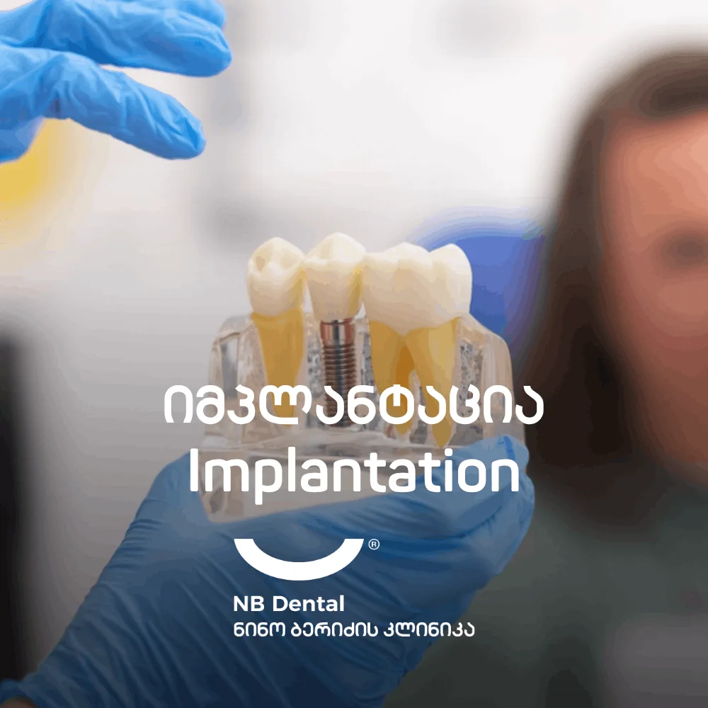Имплантация - зубные импланты в NB Dental