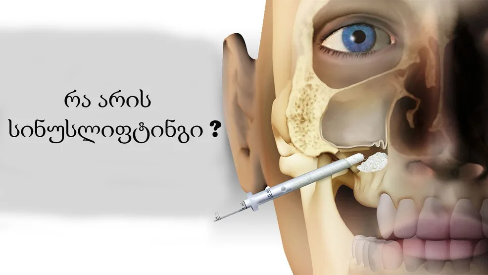 სინუსლიფტინგი, როგორც ძვლოვან-პლასტიკური ოპერაცია თანამედროვე სტომატოლოგიაში
