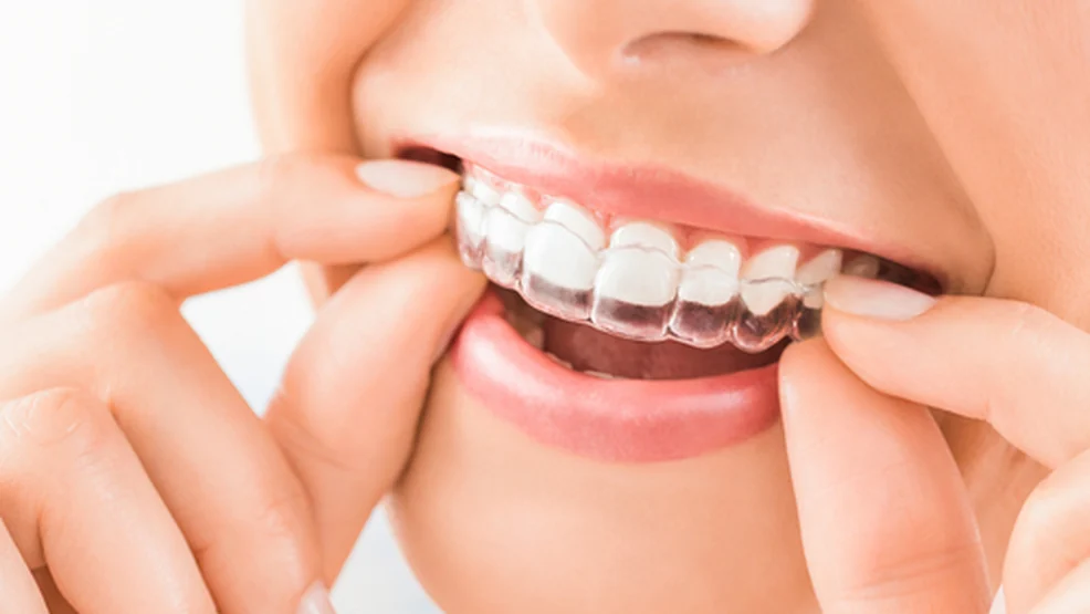 A patient fitting an Invisalign clear aligner