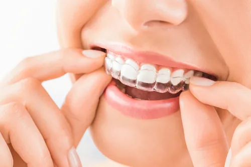 პაციენტი Invisalign-ის გამჭვირვალე კაპს იდგამს