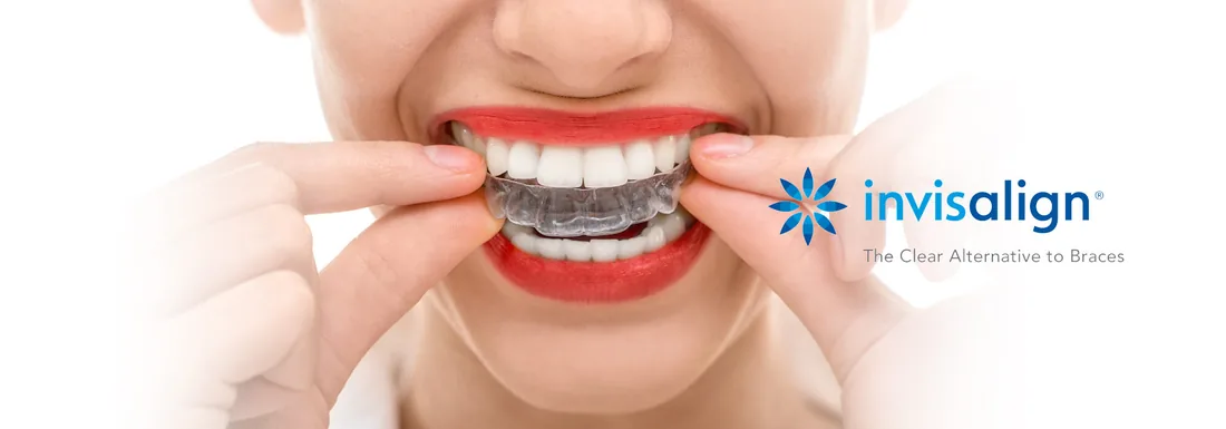 Invisalign-ის გამჭვირვალე კაპი პაციენტის კბილებზე