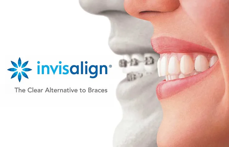 Invisalign-ის კაპები ბრეკეტებთან შედარებით