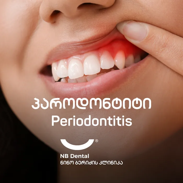 Пародонтит - лечение воспаления дёсен в NB Dental