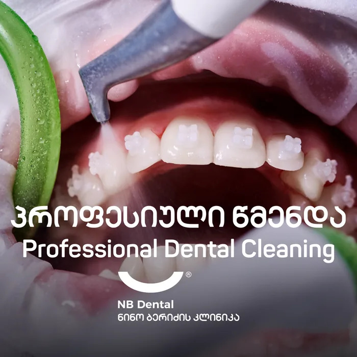 Профессиональная чистка - удаление зубного камня в NB Dental