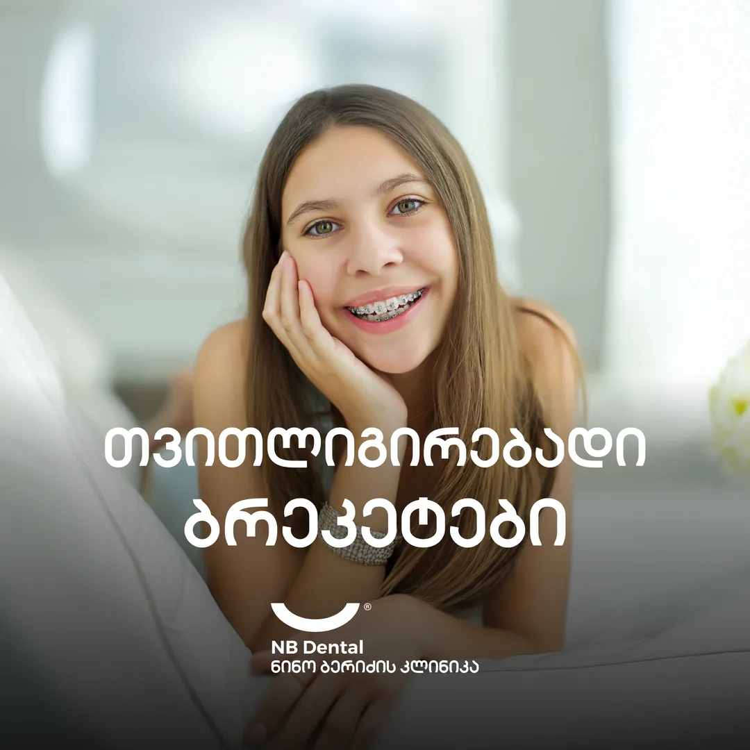 Самолигирующие брекеты - ортодонтия в NB Dental