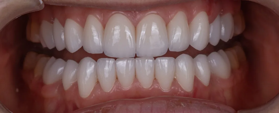 კბილების მდგომარეობა მკურნალობის შემდეგ, NB Dental