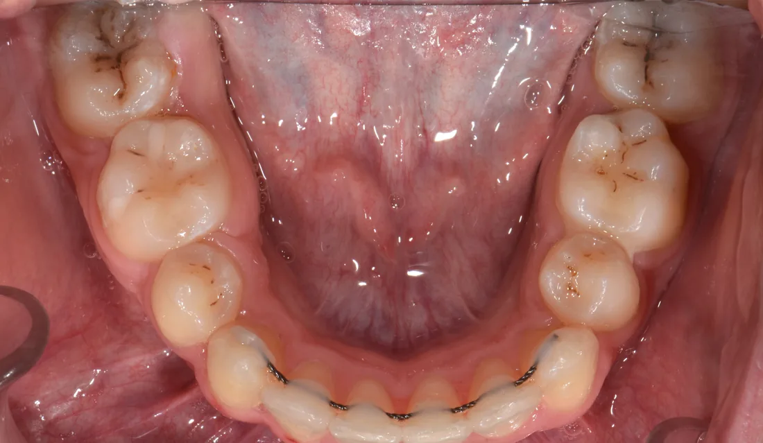 კბილების მდგომარეობა მკურნალობის შემდეგ, NB Dental