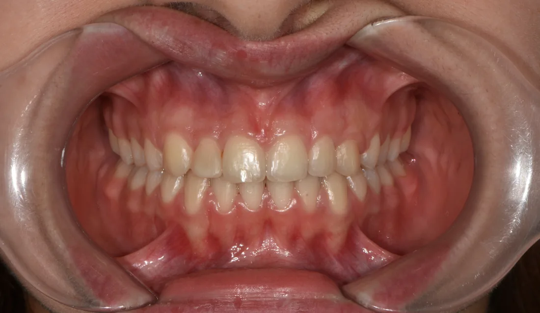 კბილების მდგომარეობა მკურნალობის შემდეგ, NB Dental