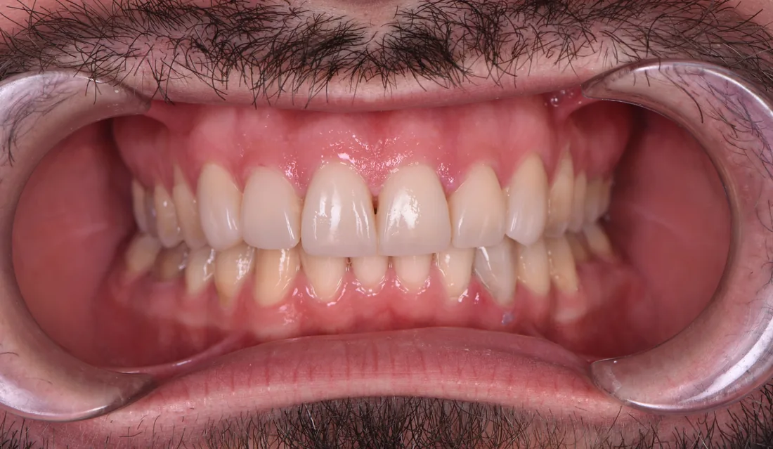 კბილების მდგომარეობა მკურნალობის შემდეგ, NB Dental