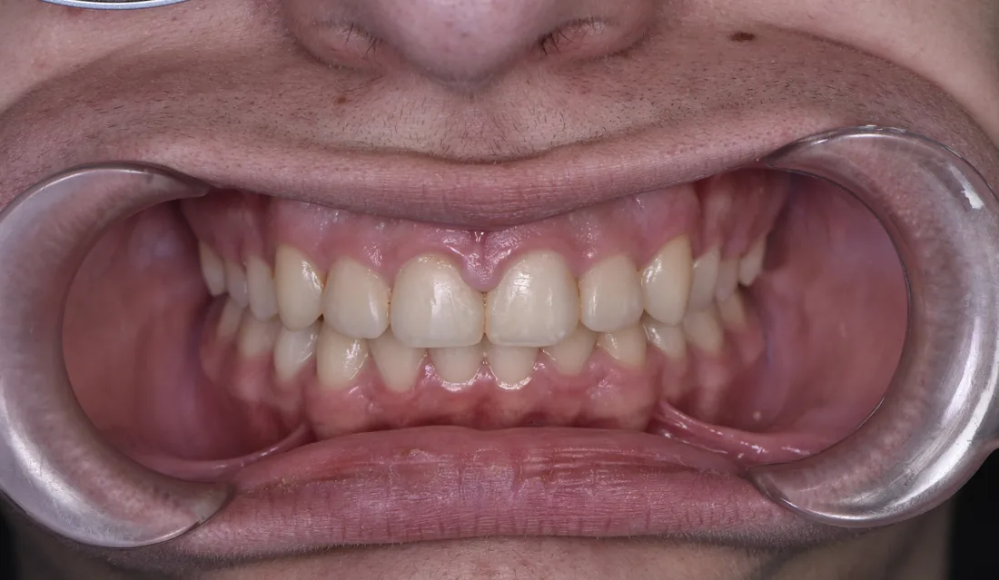 კბილების მდგომარეობა მკურნალობის შემდეგ, NB Dental