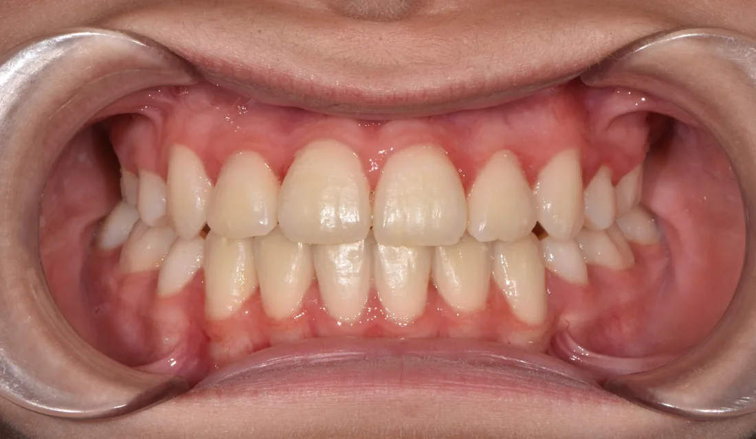 კბილების მდგომარეობა მკურნალობის შემდეგ, NB Dental