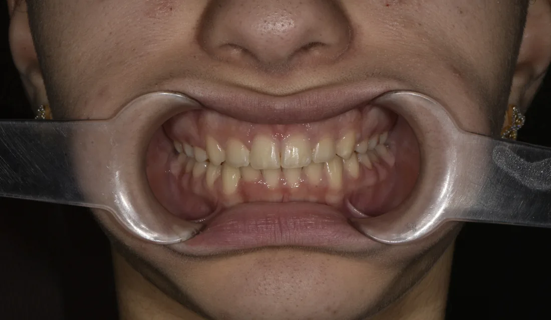 კბილების მდგომარეობა მკურნალობის შემდეგ, NB Dental