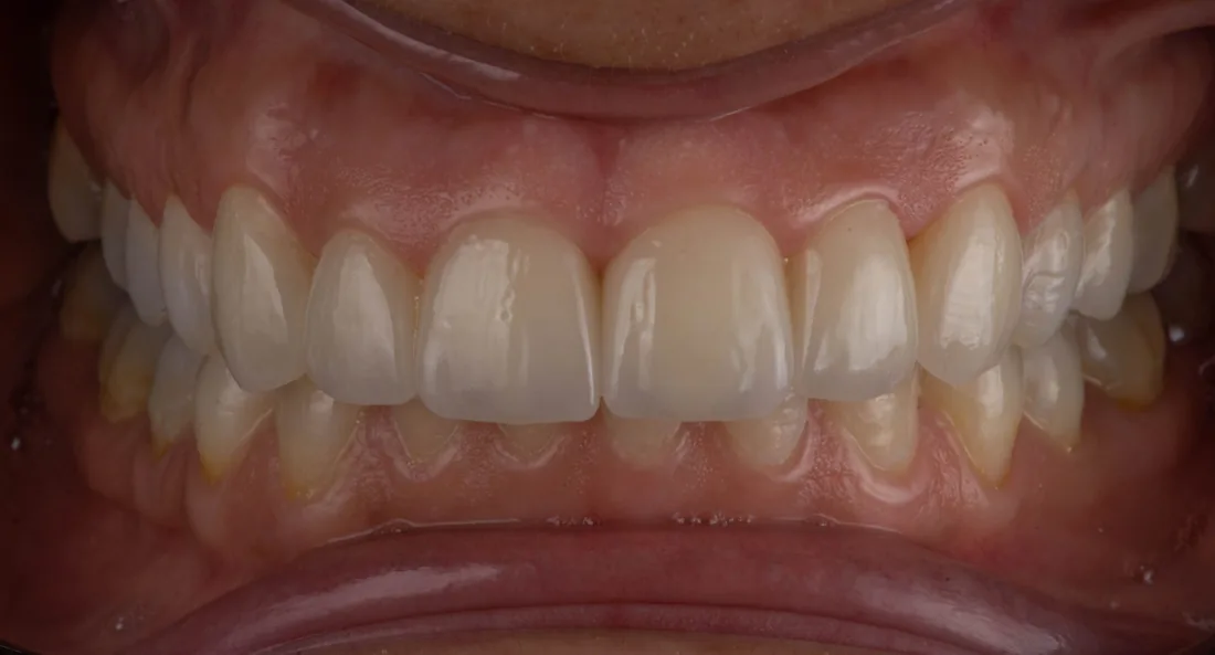 კბილების მდგომარეობა მკურნალობის შემდეგ, NB Dental