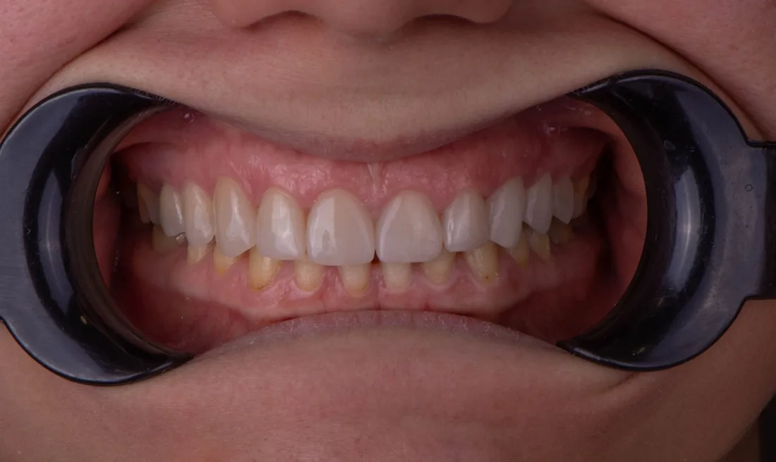 კბილების მდგომარეობა მკურნალობის შემდეგ, NB Dental