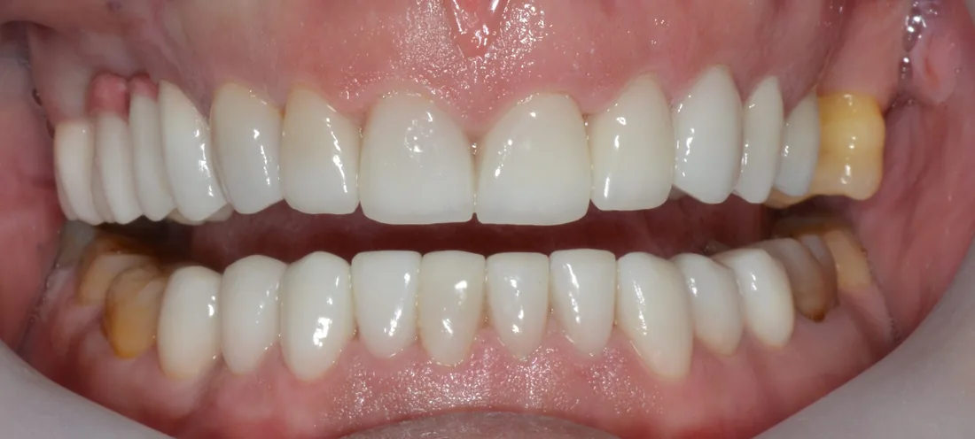 კბილების მდგომარეობა მკურნალობის შემდეგ, NB Dental