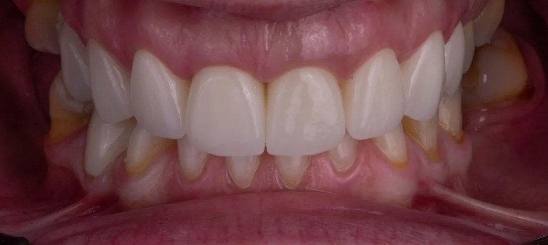 კბილების მდგომარეობა მკურნალობის შემდეგ, NB Dental