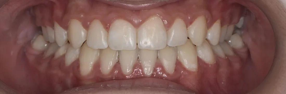 კბილების მდგომარეობა მკურნალობის შემდეგ, NB Dental