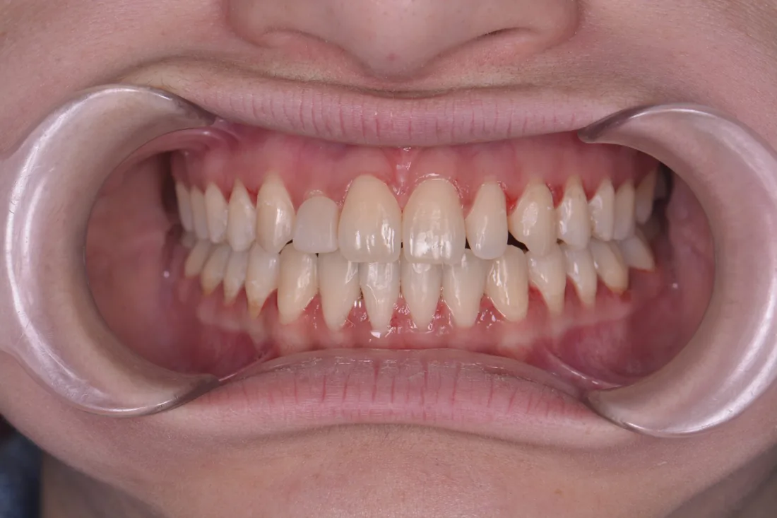 კბილების მდგომარეობა მკურნალობის შემდეგ, NB Dental