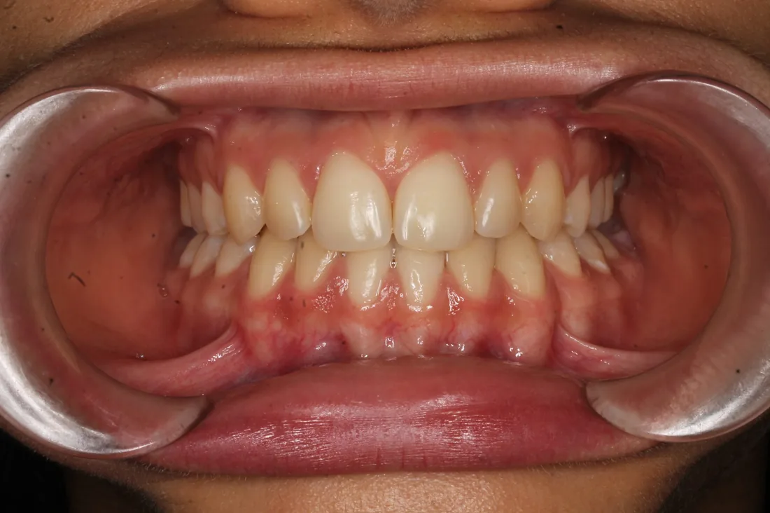 კბილების მდგომარეობა მკურნალობის შემდეგ, NB Dental