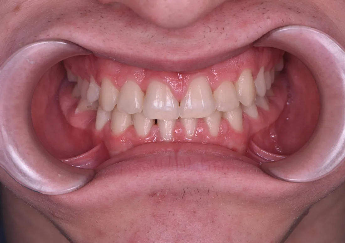 კბილების მდგომარეობა მკურნალობის შემდეგ, NB Dental