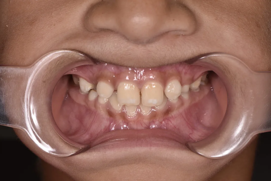 კბილების მდგომარეობა მკურნალობის შემდეგ, NB Dental