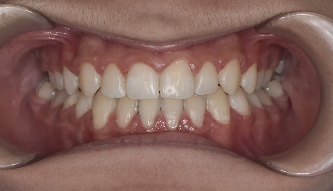 კბილების მდგომარეობა მკურნალობის შემდეგ, NB Dental