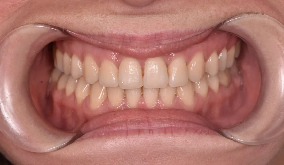 კბილების მდგომარეობა მკურნალობის შემდეგ, NB Dental