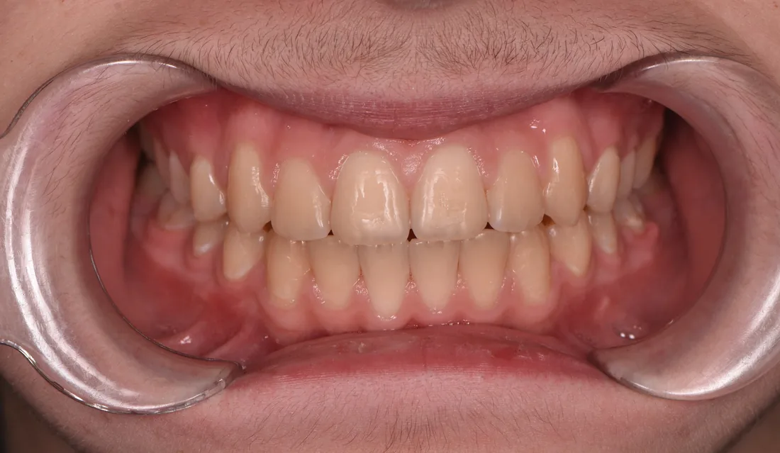 კბილების მდგომარეობა მკურნალობის შემდეგ, NB Dental
