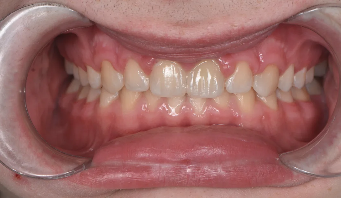 კბილების მდგომარეობა მკურნალობის შემდეგ, NB Dental