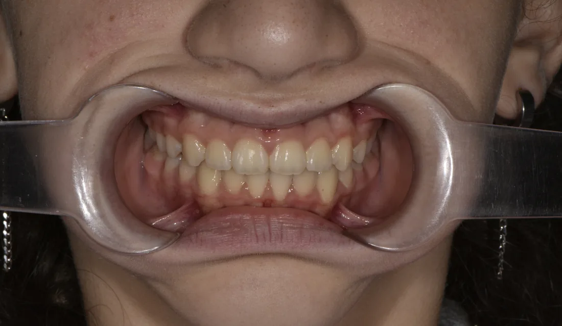 კბილების მდგომარეობა მკურნალობის შემდეგ, NB Dental