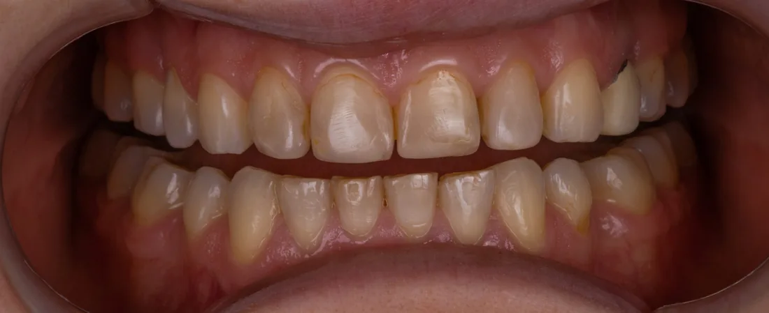 კბილების მდგომარეობა მკურნალობამდე, NB Dental