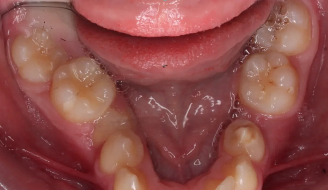 კბილების მდგომარეობა მკურნალობამდე, NB Dental
