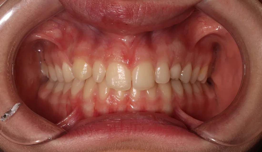 კბილების მდგომარეობა მკურნალობამდე, NB Dental