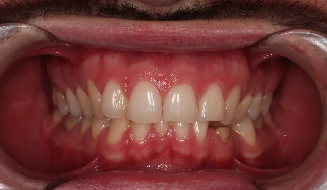 კბილების მდგომარეობა მკურნალობამდე, NB Dental