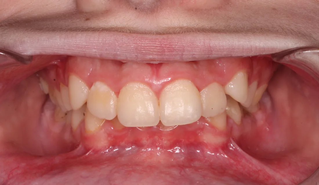 კბილების მდგომარეობა მკურნალობამდე, NB Dental