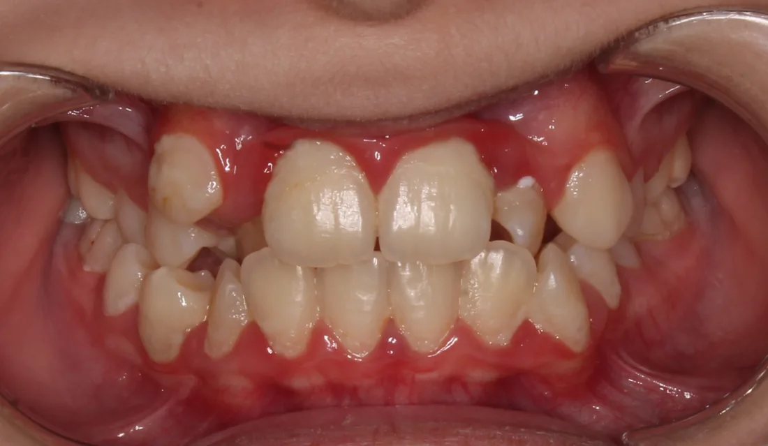 კბილების მდგომარეობა მკურნალობამდე, NB Dental