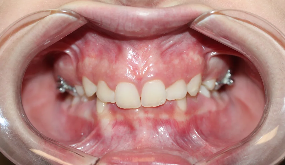 კბილების მდგომარეობა მკურნალობამდე, NB Dental