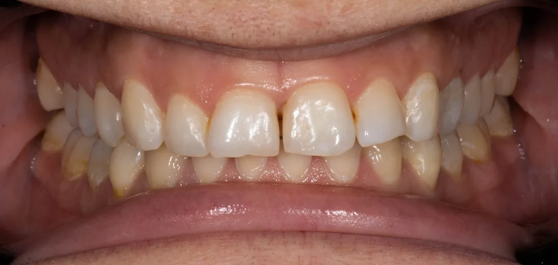 კბილების მდგომარეობა მკურნალობამდე, NB Dental