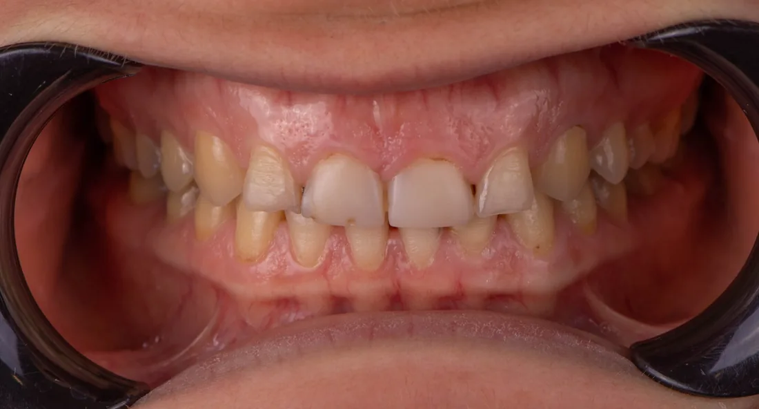 კბილების მდგომარეობა მკურნალობამდე, NB Dental