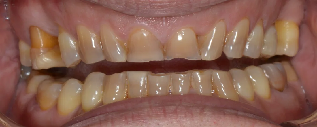 კბილების მდგომარეობა მკურნალობამდე, NB Dental