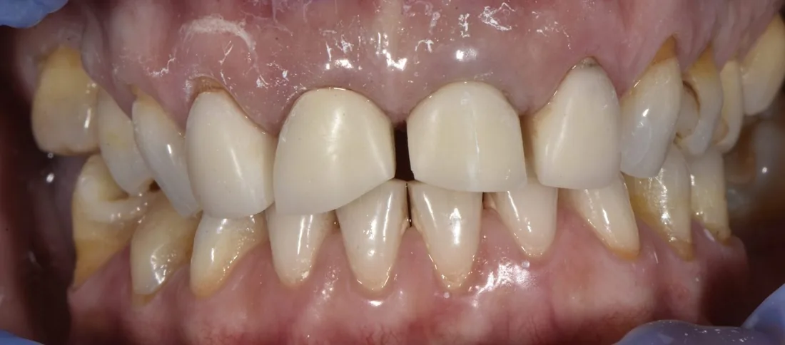 კბილების მდგომარეობა მკურნალობამდე, NB Dental