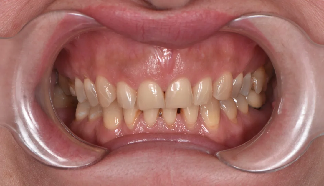 კბილების მდგომარეობა მკურნალობამდე, NB Dental
