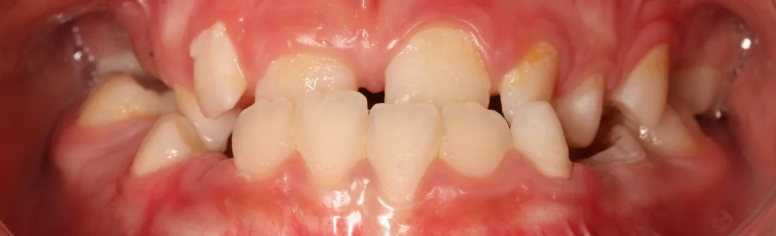 კბილების მდგომარეობა მკურნალობამდე, NB Dental