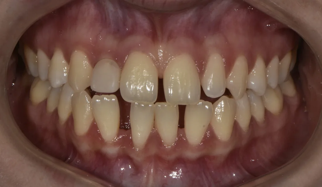 კბილების მდგომარეობა მკურნალობამდე, NB Dental