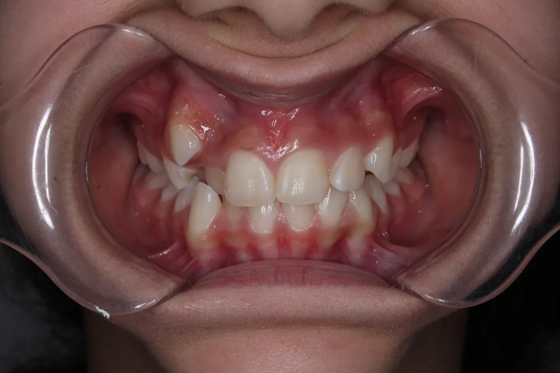 კბილების მდგომარეობა მკურნალობამდე, NB Dental