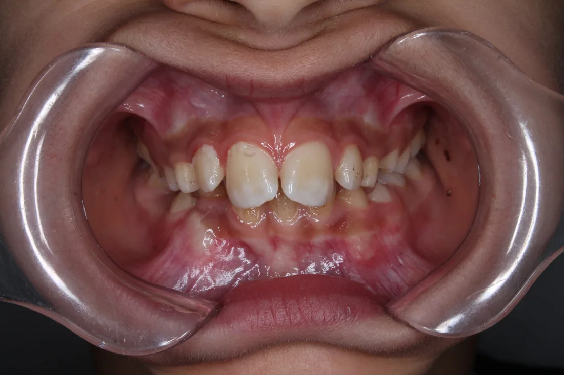 კბილების მდგომარეობა მკურნალობამდე, NB Dental